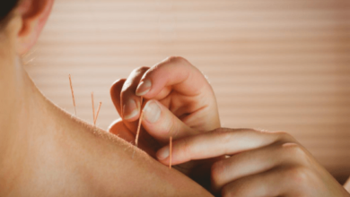 Effective Acupuncture Services for Holistic Healing