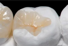 2 Innovations In Same Day Ceramic Inlay Services