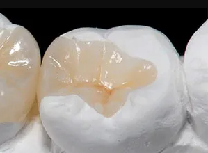 2 Innovations In Same Day Ceramic Inlay Services