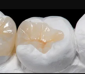 2 Innovations In Same Day Ceramic Inlay Services