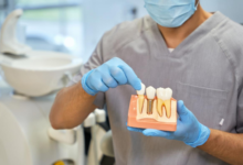 How Cosmetic Dentistry Enhances The Aesthetics Of Implants