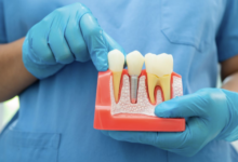 5 Benefits Of Choosing Dental Implants Over Traditional Options