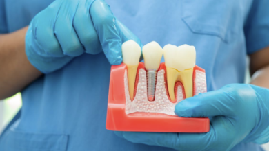5 Benefits Of Choosing Dental Implants Over Traditional Options