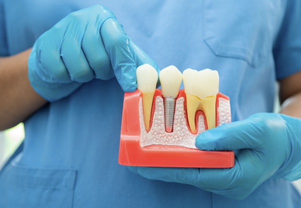 5 Benefits Of Choosing Dental Implants Over Traditional Options