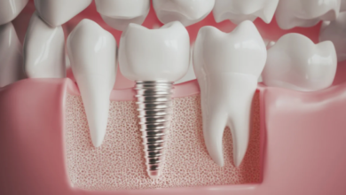 How Implant Dentistry Blends Aesthetics With Durability