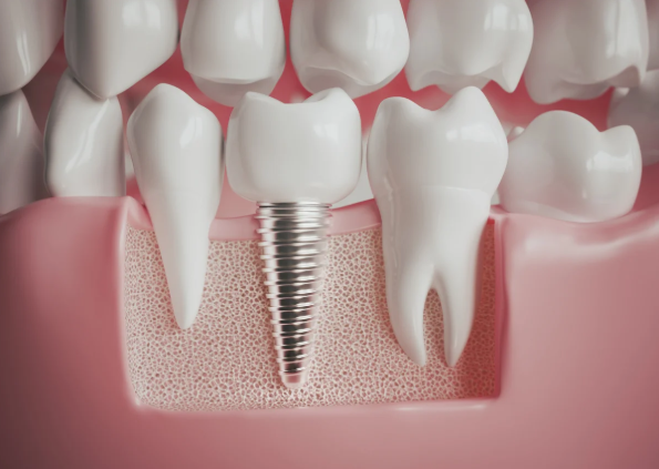 How Implant Dentistry Blends Aesthetics With Durability